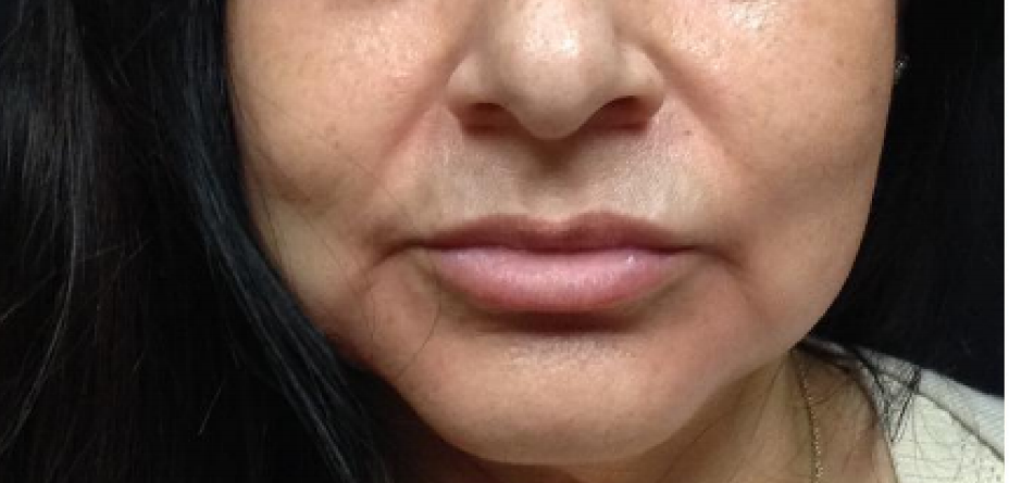 Juvéderm® filler for nasolabial folds is an effective solution for reducing the appearance of facial lines and wrinkles in the area between the nose and mouth.