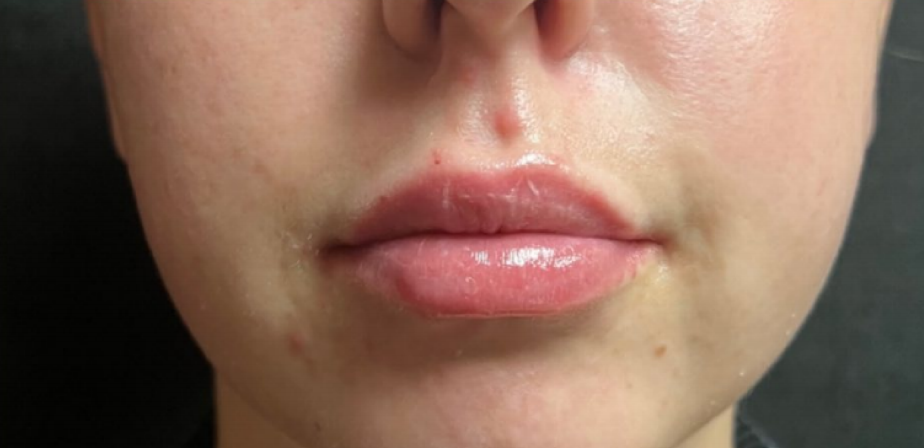 Juvéderm® Ultra XC lip filler is a cosmetic treatment used to enhance the appearance of the lips. It is a type of dermal filler that is injected into the lips to add volume and shape.