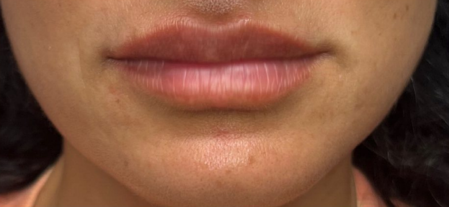 Juvéderm® Volbella@ XC lip filler is a lip filler offered by Juvéderm®.