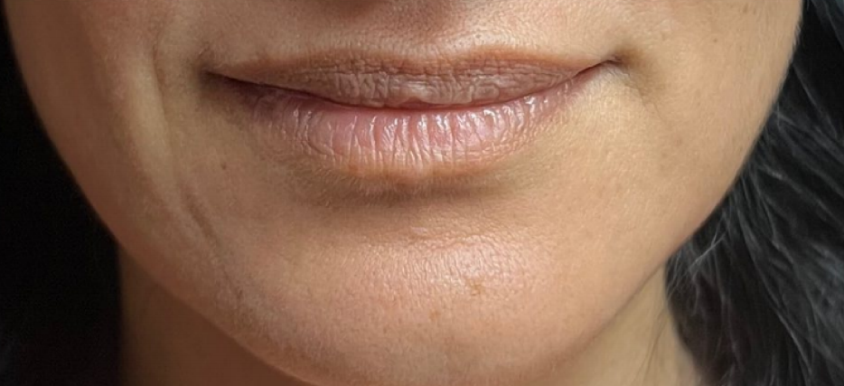 Juvéderm® Volbella@ XC lip filler is a lip filler product.
