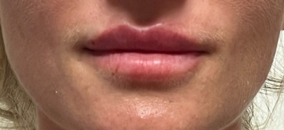 Juvéderm® Volbella@ XC lip filler is a lip filler offered by Juvéderm®.
