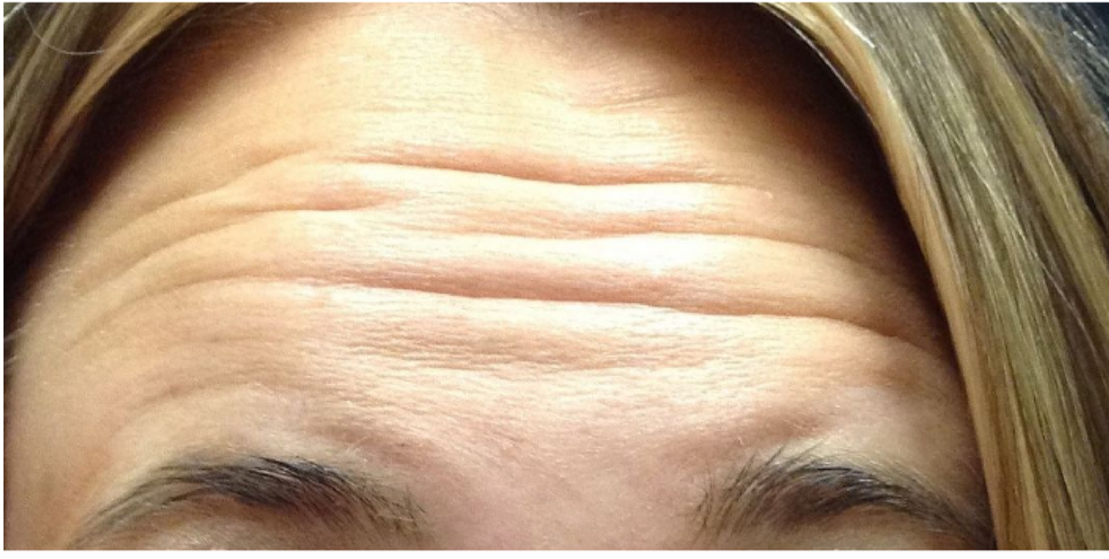 Botox® treatment applied to the forehead to reduce wrinkles and fine lines.