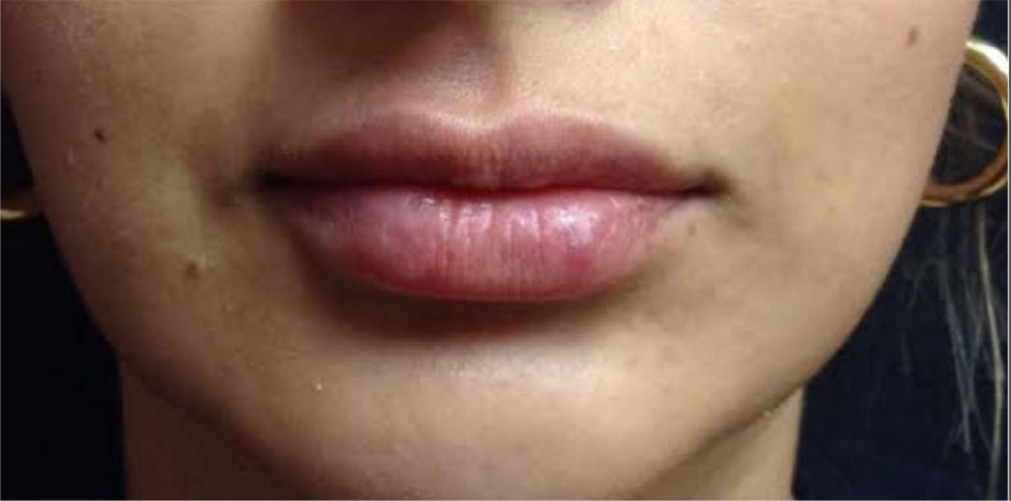 after Juvederm® Volbella® XC lip filler