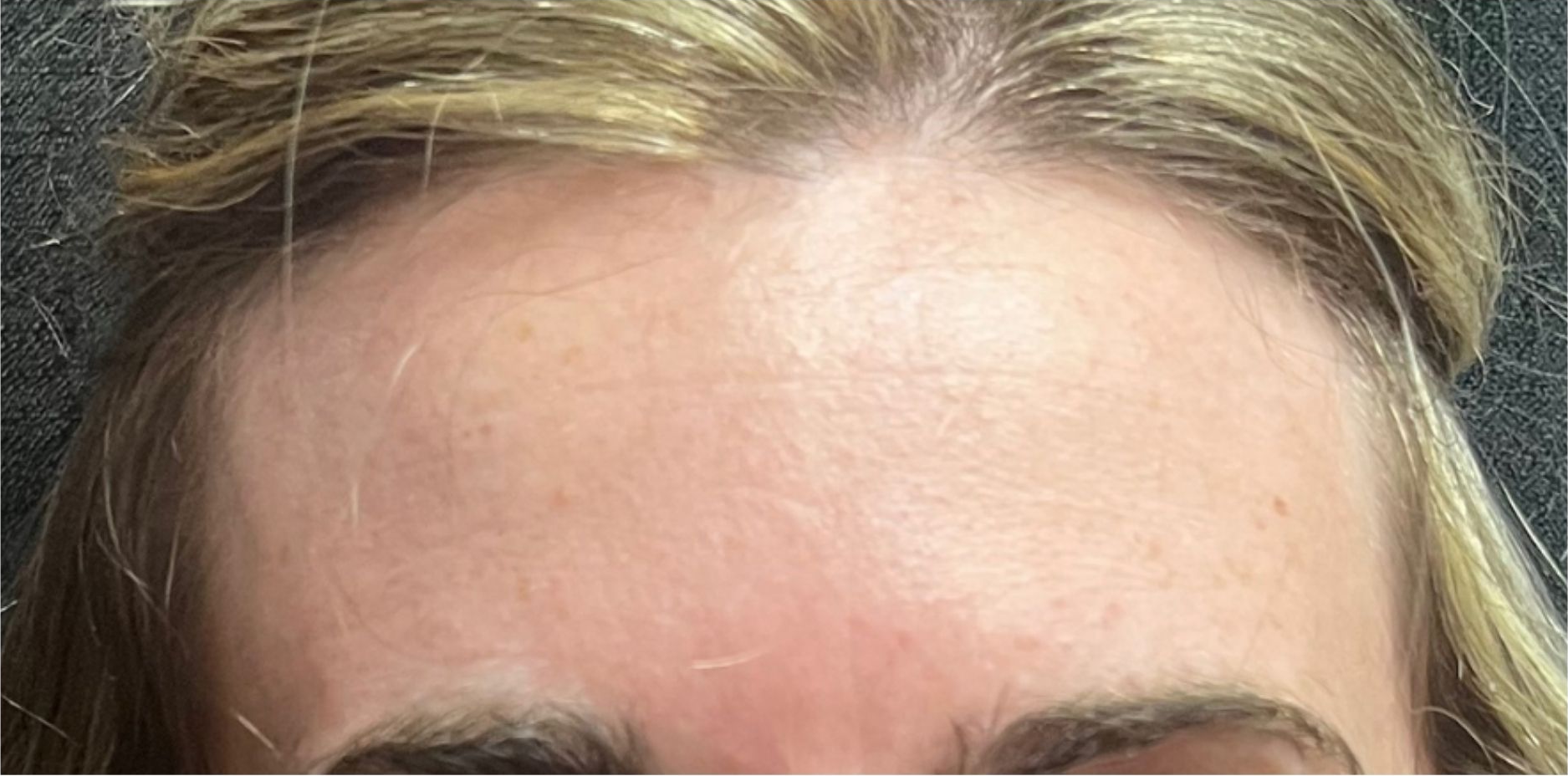 An endoscopic brow lift, also known as an endoscopic forehead lift, is a minimally invasive surgical procedure that aims to elevate the eyebrows and smooth out forehead wrinkles.